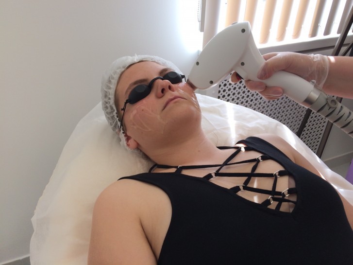 Эпиляция щёк диодным лазером